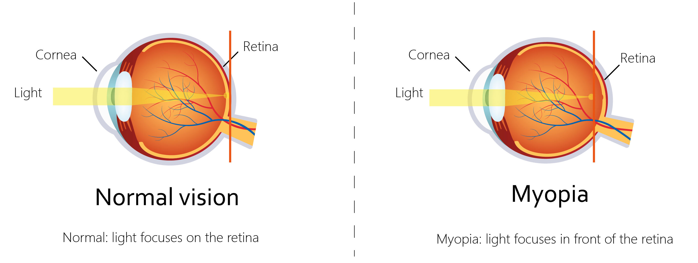 Protect-your-eyes-from-myopia—修改